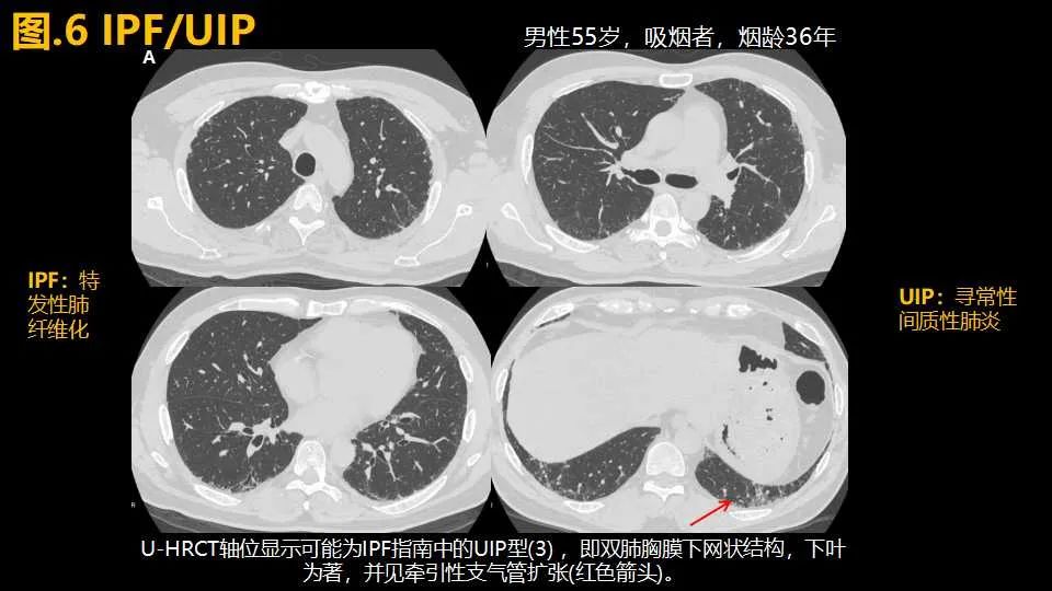 影像PPT - 【PPT】超高分辨率CT(U-HRCT)对弥漫性肺部疾病的放射-病理相关性探究：从Miller\'s到Reid\'s小叶-8