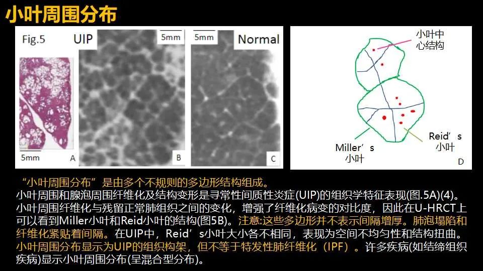 影像PPT - 【PPT】超高分辨率CT(U-HRCT)对弥漫性肺部疾病的放射-病理相关性探究：从Miller\'s到Reid\'s小叶-7