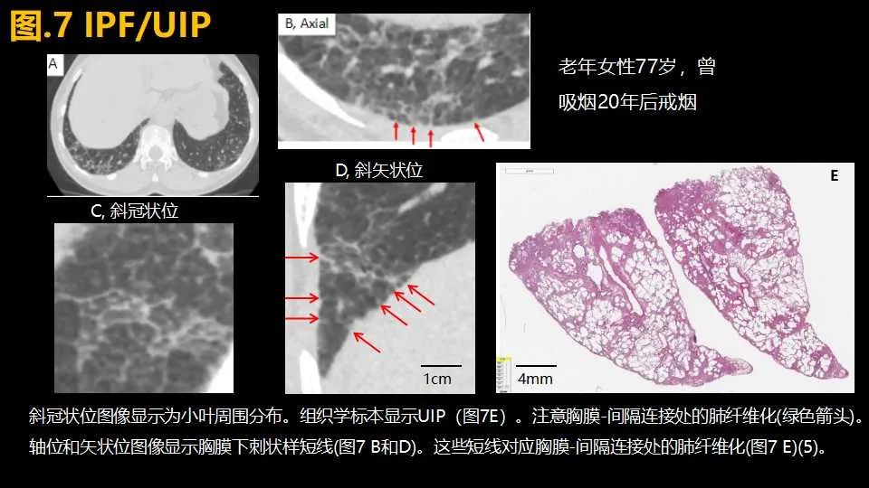 影像PPT - 【PPT】超高分辨率CT(U-HRCT)对弥漫性肺部疾病的放射-病理相关性探究：从Miller\'s到Reid\'s小叶-10