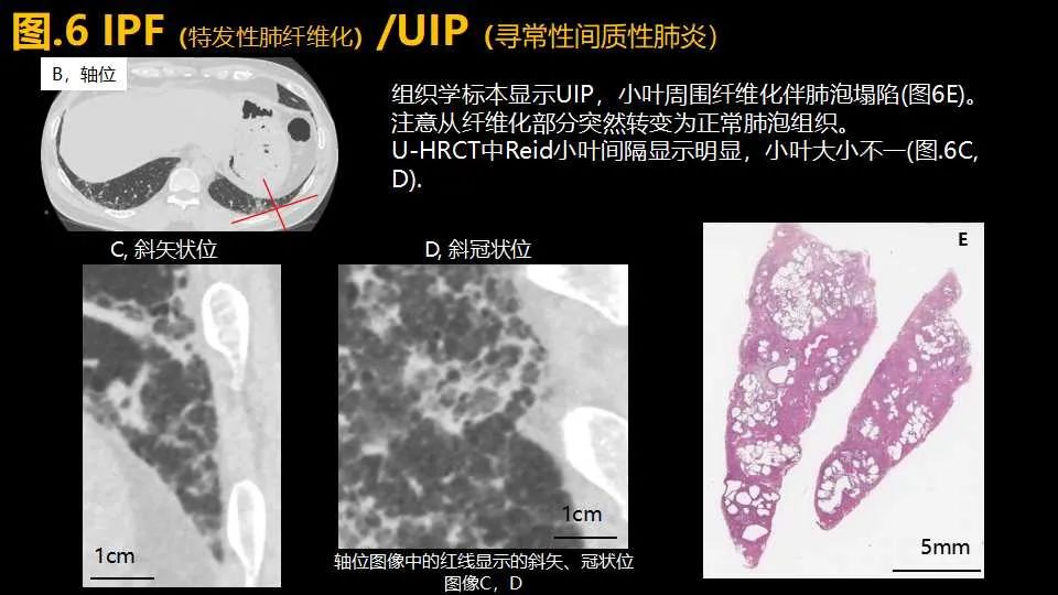 影像PPT - 【PPT】超高分辨率CT(U-HRCT)对弥漫性肺部疾病的放射-病理相关性探究：从Miller\'s到Reid\'s小叶-9