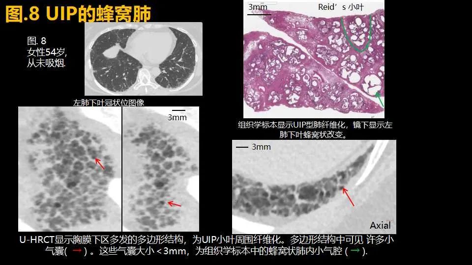 影像PPT - 【PPT】超高分辨率CT(U-HRCT)对弥漫性肺部疾病的放射-病理相关性探究：从Miller\'s到Reid\'s小叶-11