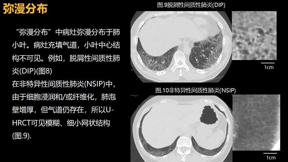 影像PPT - 【PPT】超高分辨率CT(U-HRCT)对弥漫性肺部疾病的放射-病理相关性探究：从Miller\'s到Reid\'s小叶-12