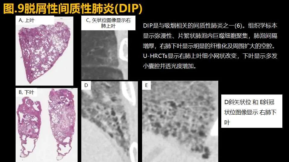 影像PPT - 【PPT】超高分辨率CT(U-HRCT)对弥漫性肺部疾病的放射-病理相关性探究：从Miller\'s到Reid\'s小叶-13