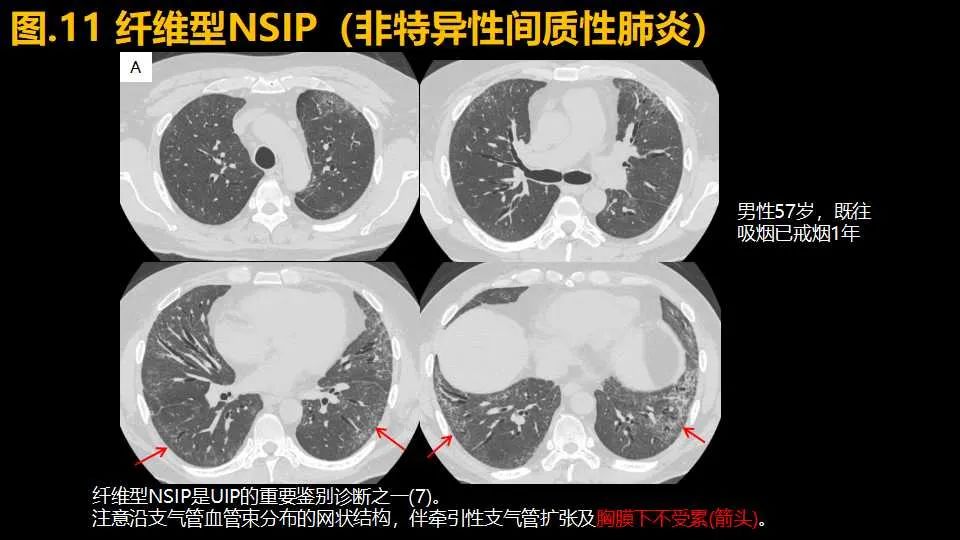 影像PPT - 【PPT】超高分辨率CT(U-HRCT)对弥漫性肺部疾病的放射-病理相关性探究：从Miller\'s到Reid\'s小叶-15