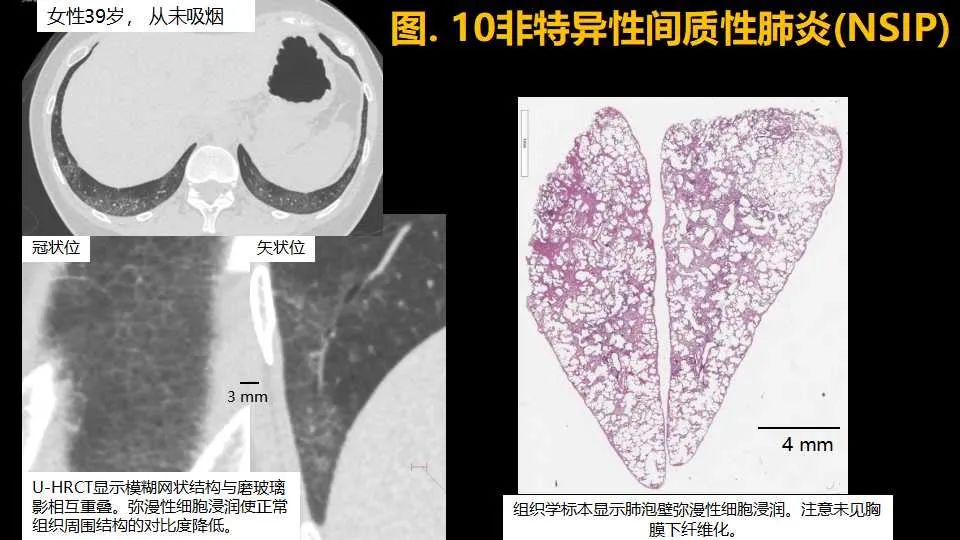 影像PPT - 【PPT】超高分辨率CT(U-HRCT)对弥漫性肺部疾病的放射-病理相关性探究：从Miller\'s到Reid\'s小叶-14