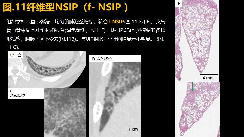 影像PPT - 【PPT】超高分辨率CT(U-HRCT)对弥漫性肺部疾病的放射-病理相关性探究：从Miller\'s到Reid\'s小叶-16