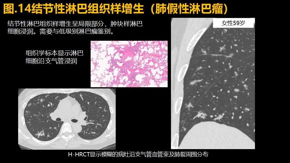 影像PPT - 【PPT】超高分辨率CT(U-HRCT)对弥漫性肺部疾病的放射-病理相关性探究：从Miller\'s到Reid\'s小叶-19