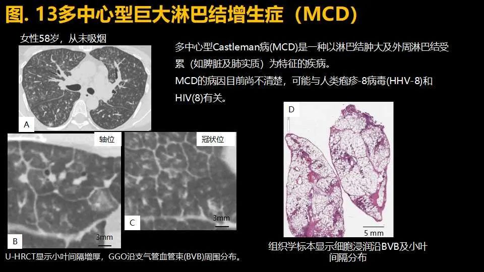 影像PPT - 【PPT】超高分辨率CT(U-HRCT)对弥漫性肺部疾病的放射-病理相关性探究：从Miller\'s到Reid\'s小叶-18
