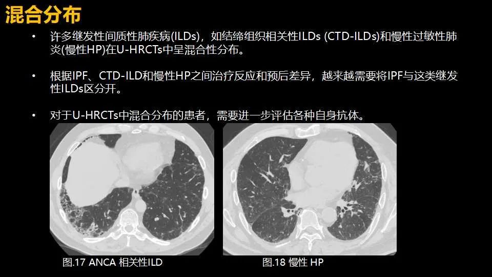影像PPT - 【PPT】超高分辨率CT(U-HRCT)对弥漫性肺部疾病的放射-病理相关性探究：从Miller\'s到Reid\'s小叶-23