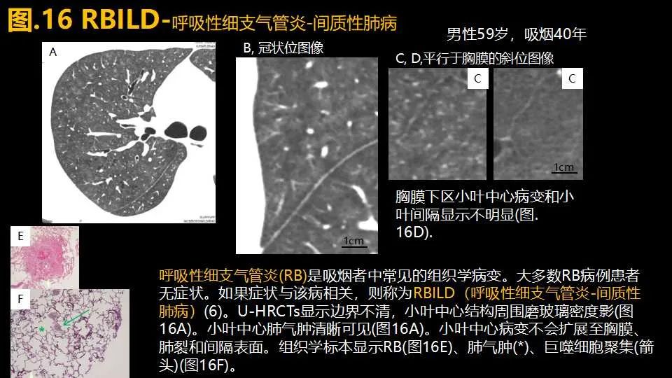 影像PPT - 【PPT】超高分辨率CT(U-HRCT)对弥漫性肺部疾病的放射-病理相关性探究：从Miller\'s到Reid\'s小叶-22