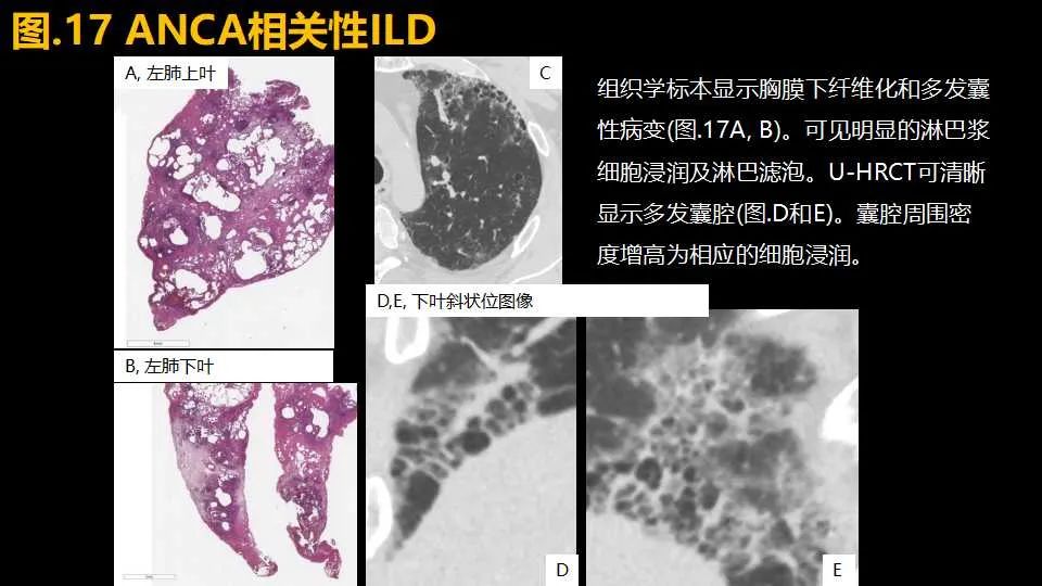影像PPT - 【PPT】超高分辨率CT(U-HRCT)对弥漫性肺部疾病的放射-病理相关性探究：从Miller\'s到Reid\'s小叶-25