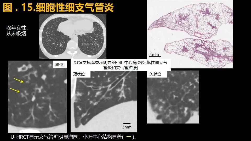 影像PPT - 【PPT】超高分辨率CT(U-HRCT)对弥漫性肺部疾病的放射-病理相关性探究：从Miller\'s到Reid\'s小叶-21
