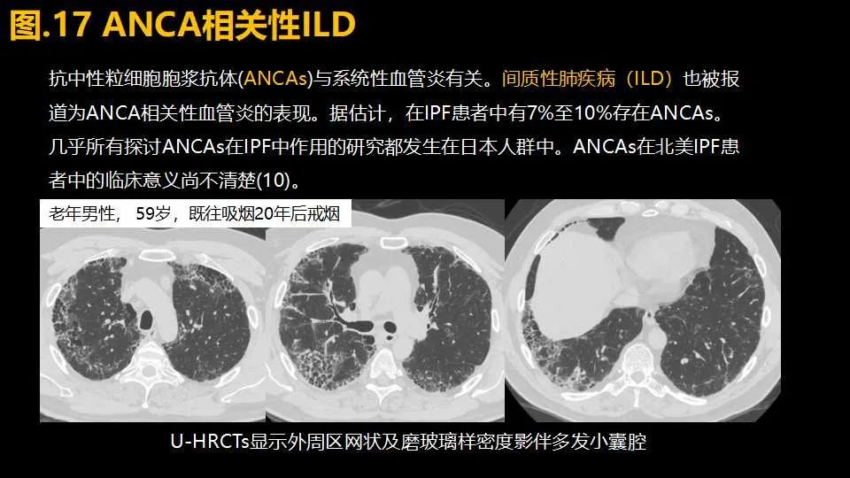 影像PPT - 【PPT】超高分辨率CT(U-HRCT)对弥漫性肺部疾病的放射-病理相关性探究：从Miller\'s到Reid\'s小叶-24