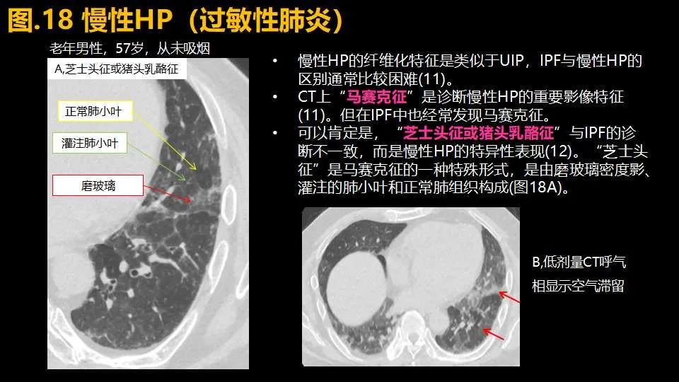 影像PPT - 【PPT】超高分辨率CT(U-HRCT)对弥漫性肺部疾病的放射-病理相关性探究：从Miller\'s到Reid\'s小叶-26
