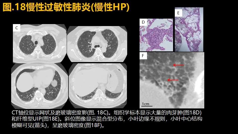 影像PPT - 【PPT】超高分辨率CT(U-HRCT)对弥漫性肺部疾病的放射-病理相关性探究：从Miller\'s到Reid\'s小叶-27