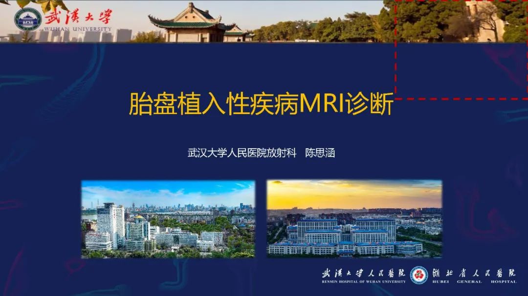 影像PPT - 【PPT】胎盘植入性疾病MRI诊断-1