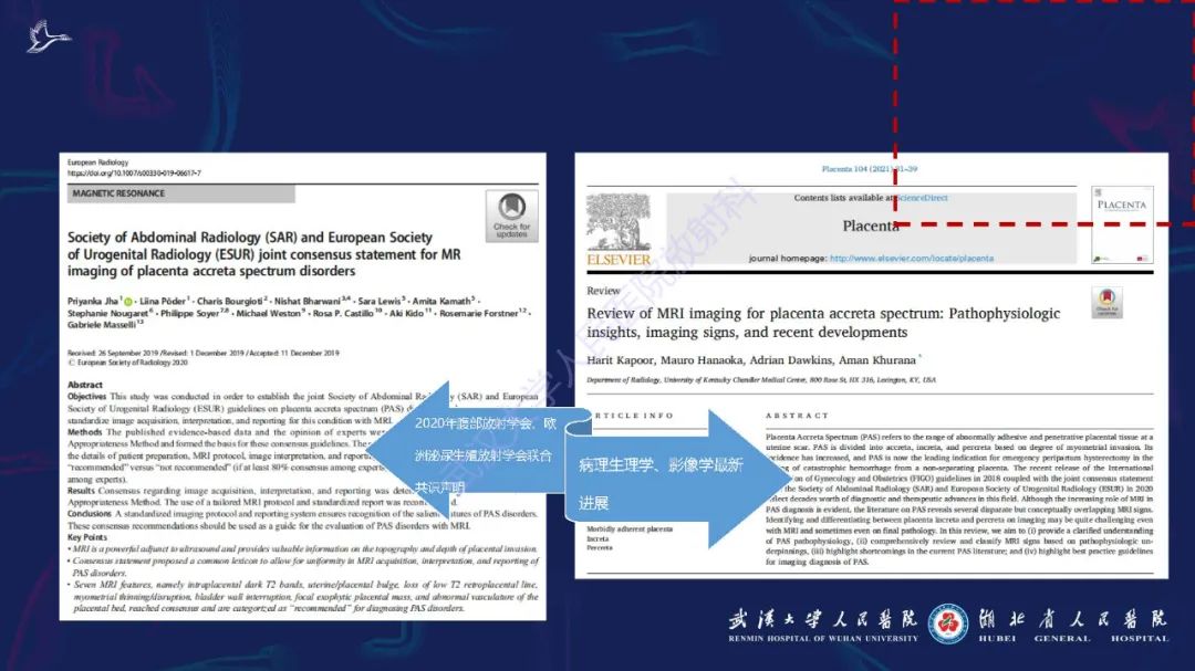 影像PPT - 【PPT】胎盘植入性疾病MRI诊断-2