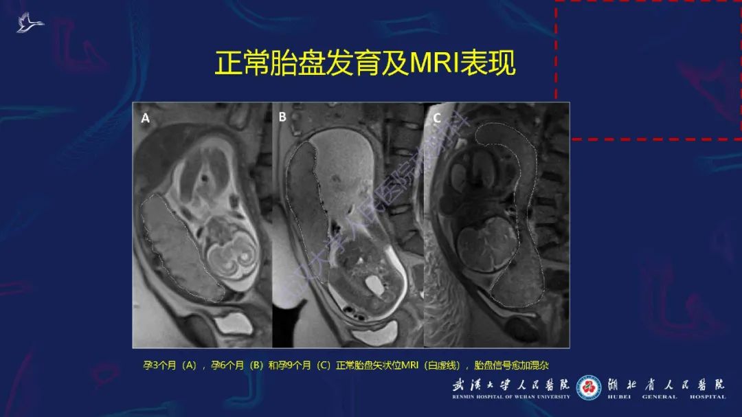 影像PPT - 【PPT】胎盘植入性疾病MRI诊断-11