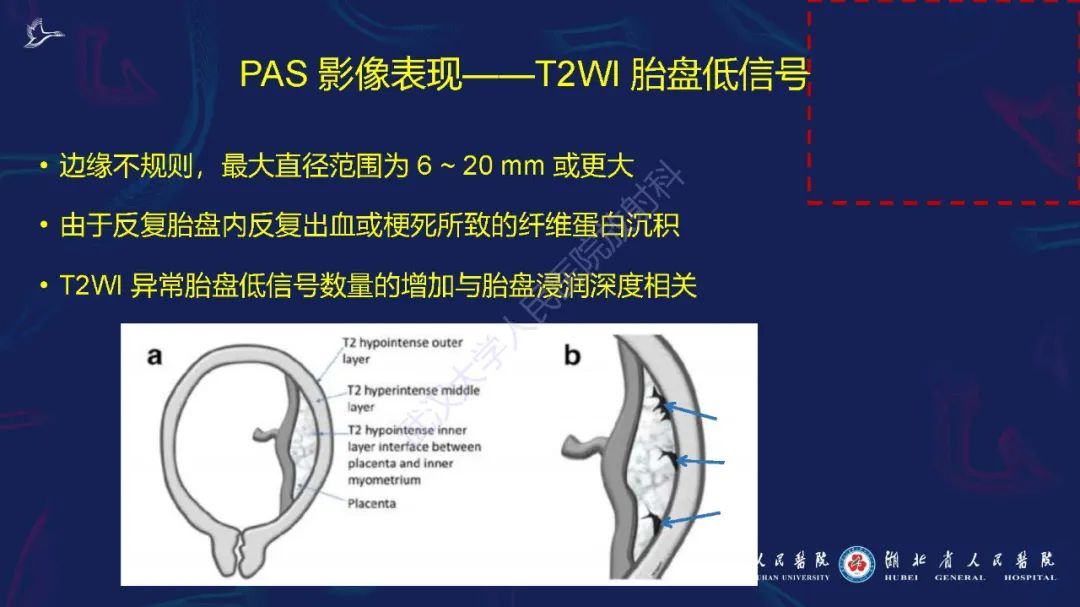 影像PPT - 【PPT】胎盘植入性疾病MRI诊断-14