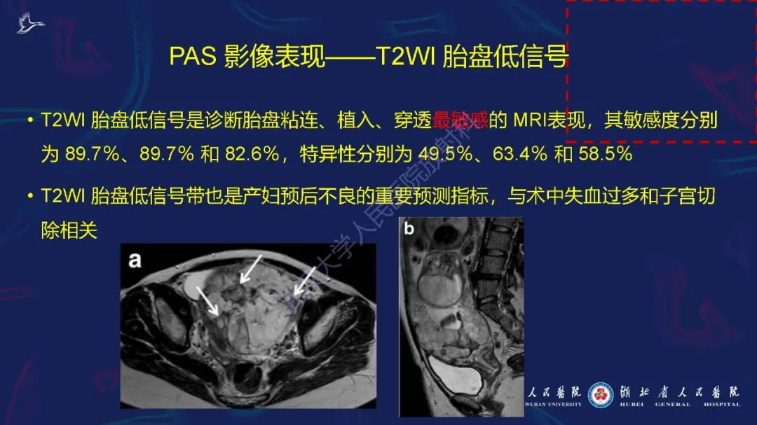 影像PPT - 【PPT】胎盘植入性疾病MRI诊断-15