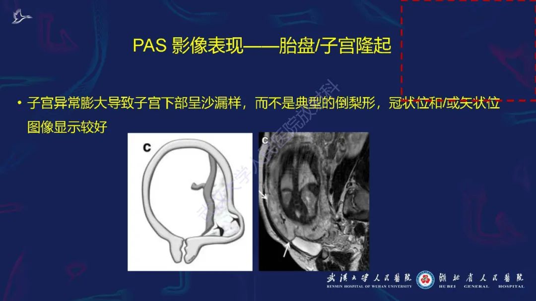 影像PPT - 【PPT】胎盘植入性疾病MRI诊断-16