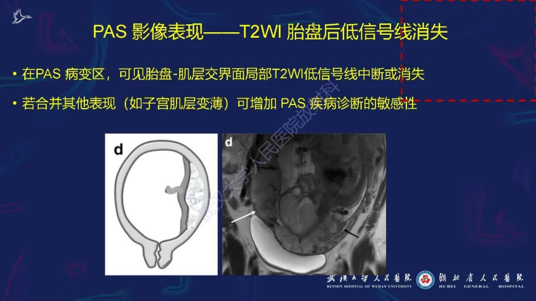 影像PPT - 【PPT】胎盘植入性疾病MRI诊断-18
