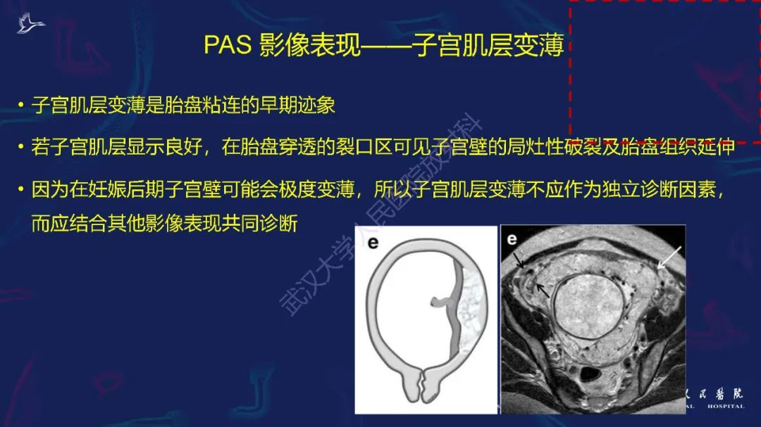 影像PPT - 【PPT】胎盘植入性疾病MRI诊断-19