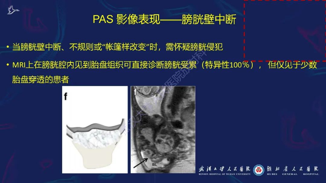影像PPT - 【PPT】胎盘植入性疾病MRI诊断-20
