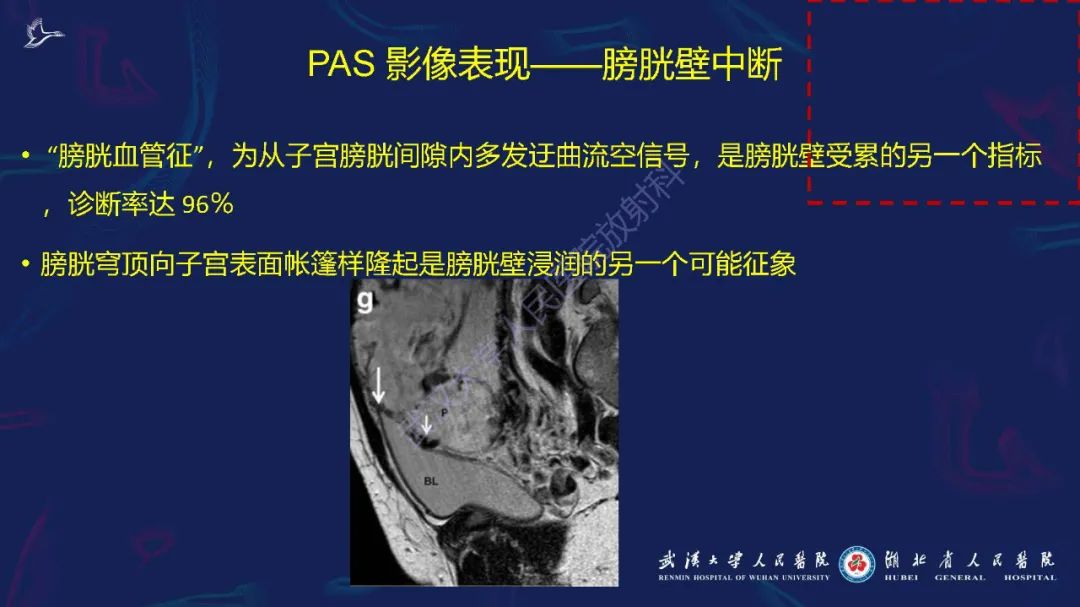 影像PPT - 【PPT】胎盘植入性疾病MRI诊断-21