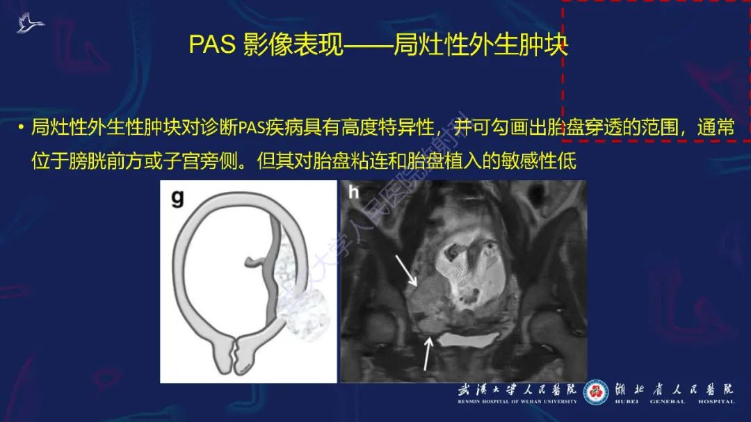 影像PPT - 【PPT】胎盘植入性疾病MRI诊断-22