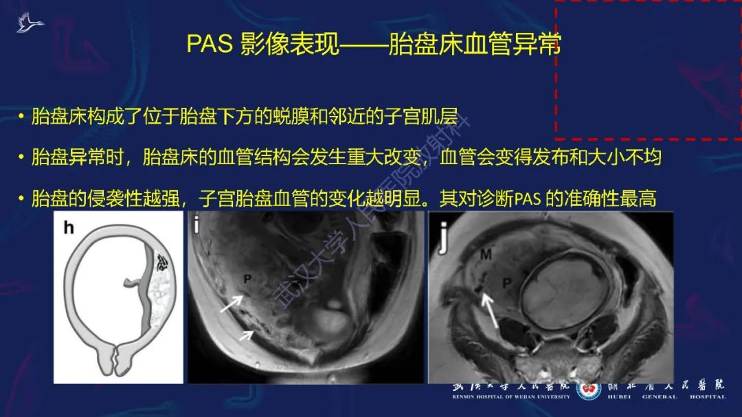 影像PPT - 【PPT】胎盘植入性疾病MRI诊断-23