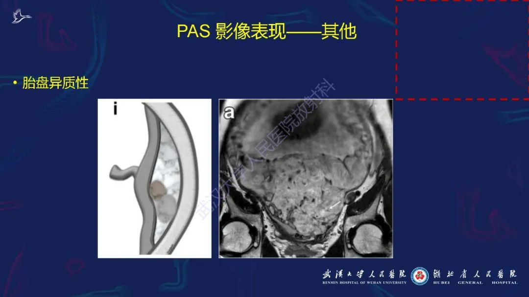 影像PPT - 【PPT】胎盘植入性疾病MRI诊断-24