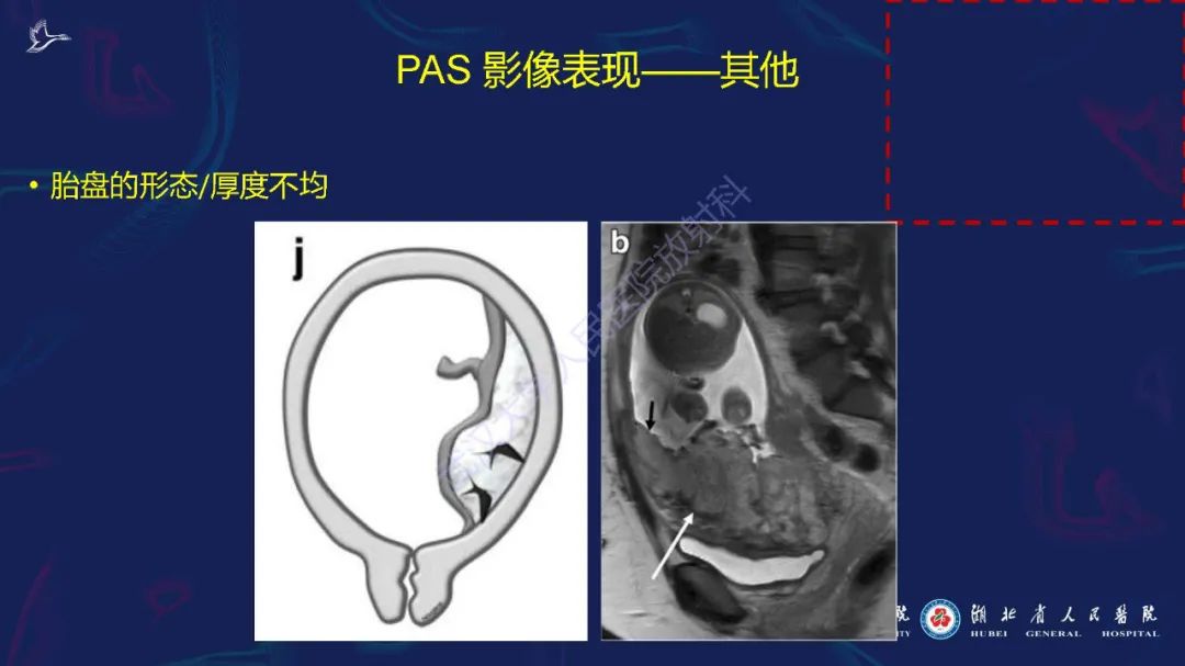 影像PPT - 【PPT】胎盘植入性疾病MRI诊断-25