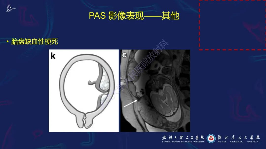 影像PPT - 【PPT】胎盘植入性疾病MRI诊断-26