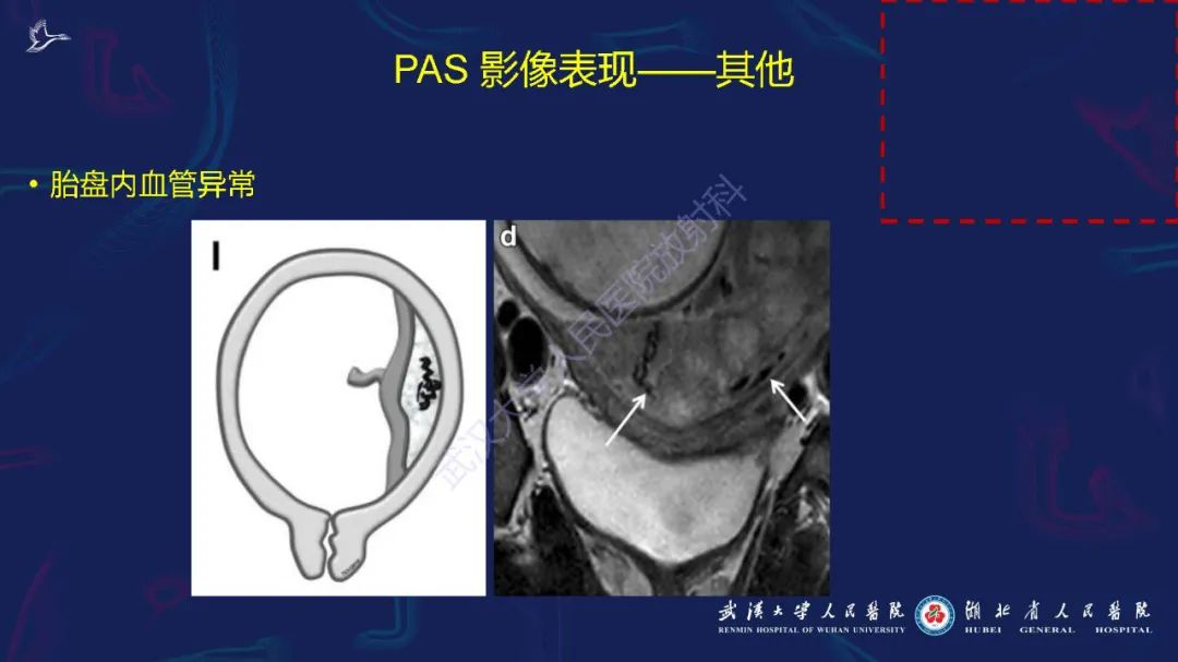 影像PPT - 【PPT】胎盘植入性疾病MRI诊断-27