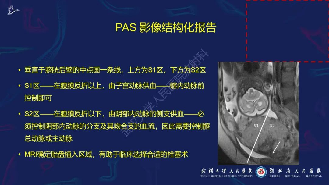影像PPT - 【PPT】胎盘植入性疾病MRI诊断-33