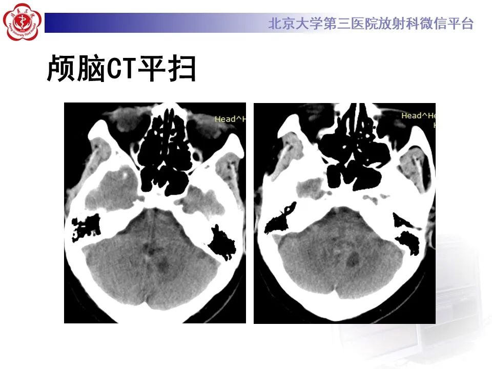 影像PPT - 【病例】四脑室毛细胞型星形细胞瘤1例MR影像-3