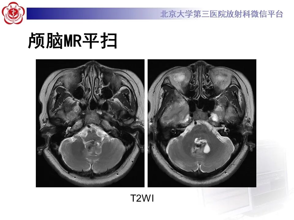 影像PPT - 【病例】四脑室毛细胞型星形细胞瘤1例MR影像-4