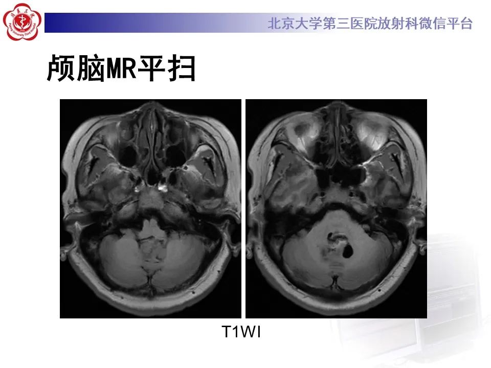 影像PPT - 【病例】四脑室毛细胞型星形细胞瘤1例MR影像-5