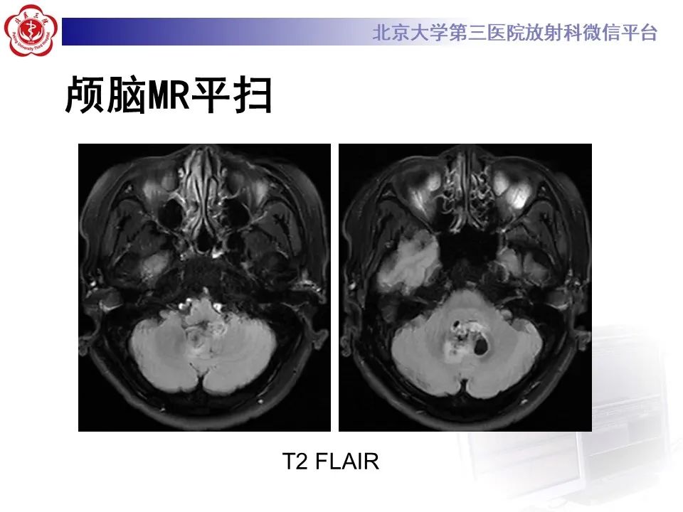 影像PPT - 【病例】四脑室毛细胞型星形细胞瘤1例MR影像-6