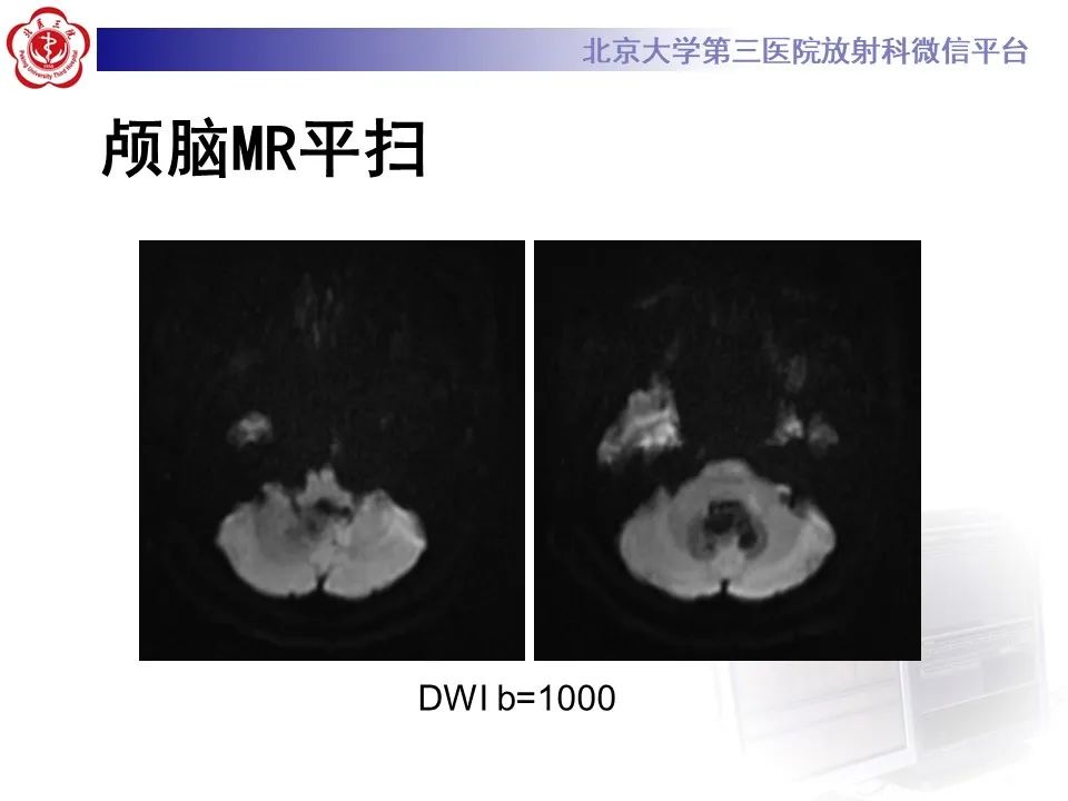 影像PPT - 【病例】四脑室毛细胞型星形细胞瘤1例MR影像-8