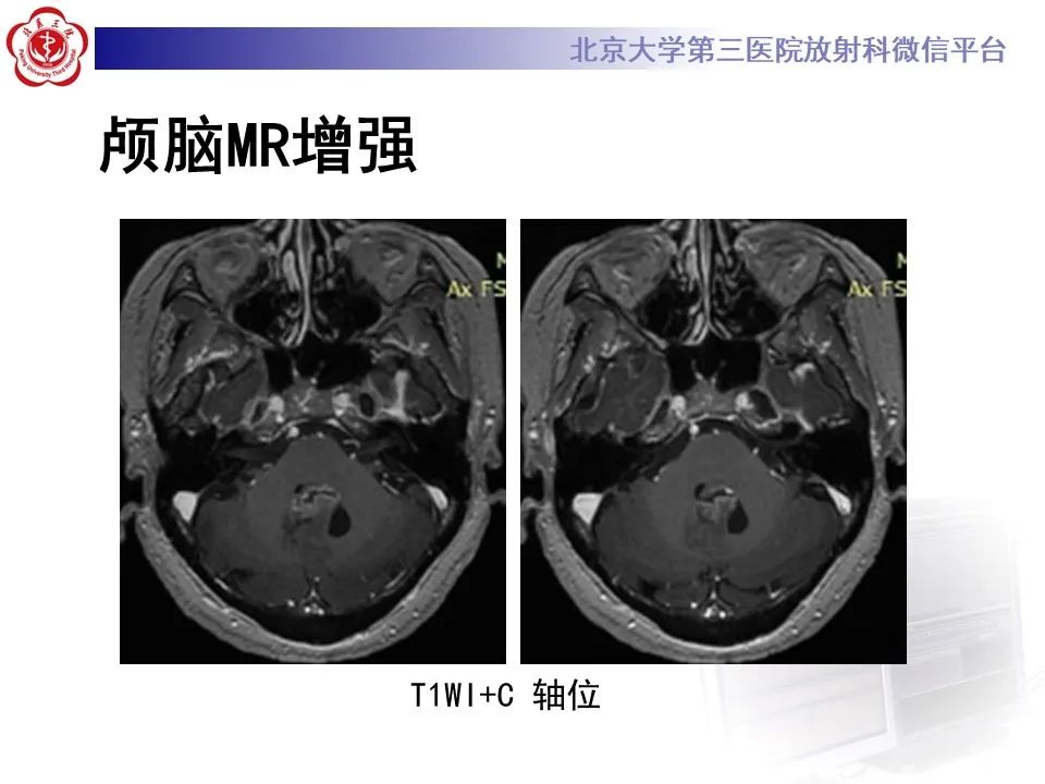 影像PPT - 【病例】四脑室毛细胞型星形细胞瘤1例MR影像-11