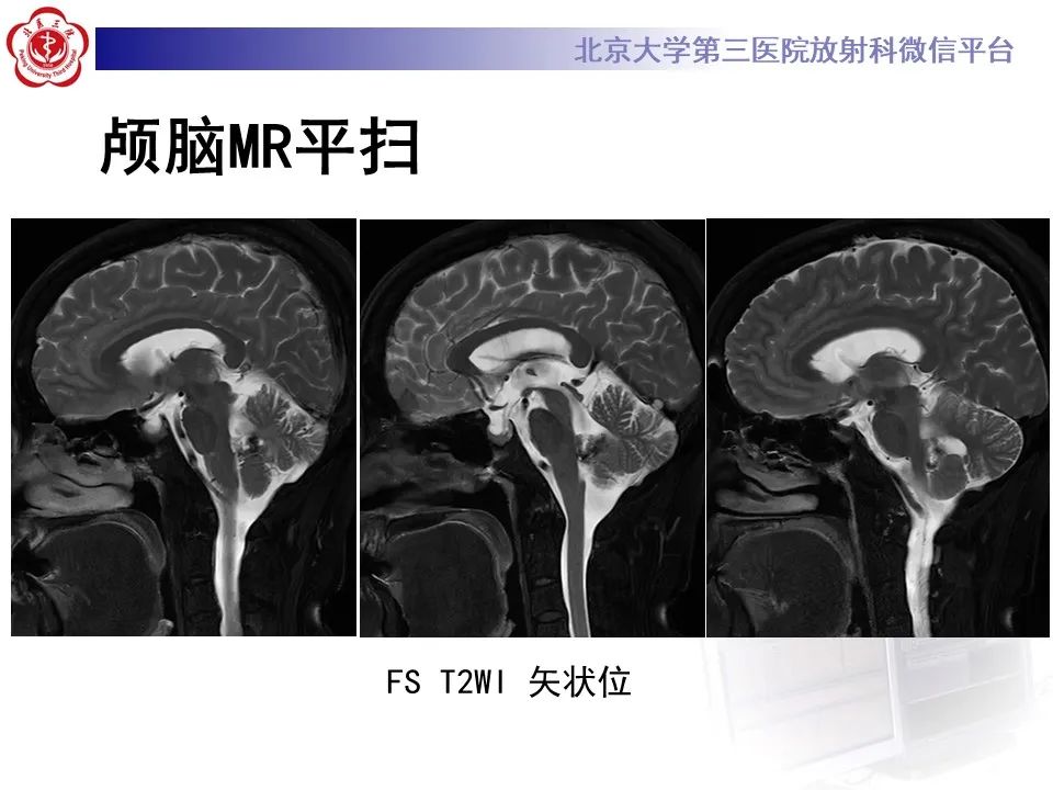 影像PPT - 【病例】四脑室毛细胞型星形细胞瘤1例MR影像-7
