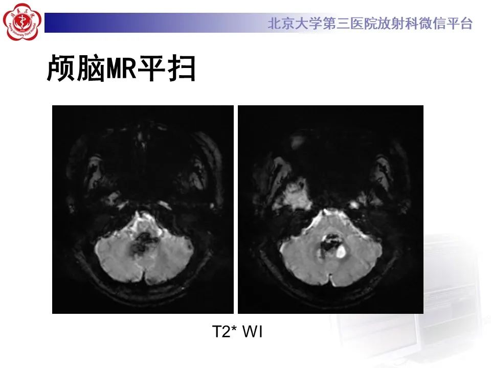 影像PPT - 【病例】四脑室毛细胞型星形细胞瘤1例MR影像-10
