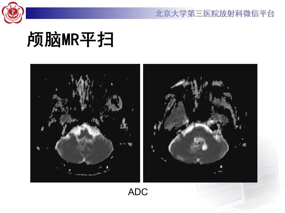 影像PPT - 【病例】四脑室毛细胞型星形细胞瘤1例MR影像-9