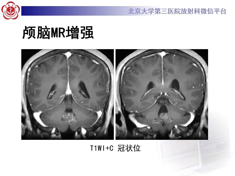 影像PPT - 【病例】四脑室毛细胞型星形细胞瘤1例MR影像-12