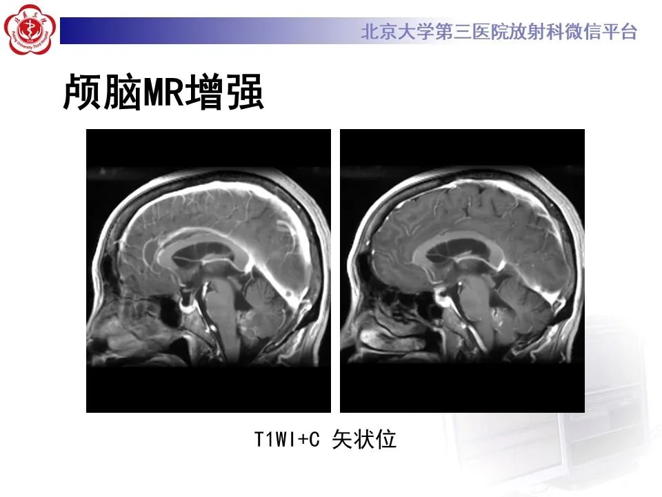 影像PPT - 【病例】四脑室毛细胞型星形细胞瘤1例MR影像-13