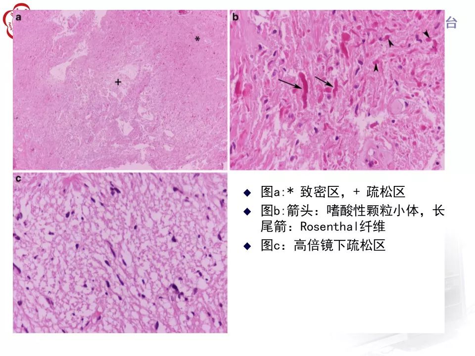 影像PPT - 【病例】四脑室毛细胞型星形细胞瘤1例MR影像-21