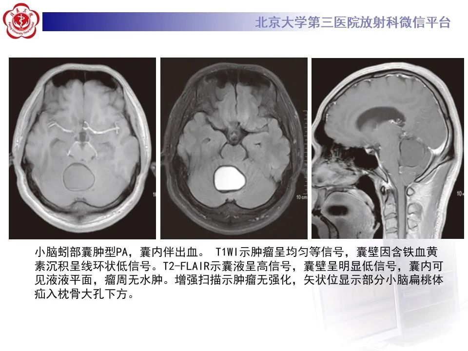 影像PPT - 【病例】四脑室毛细胞型星形细胞瘤1例MR影像-24