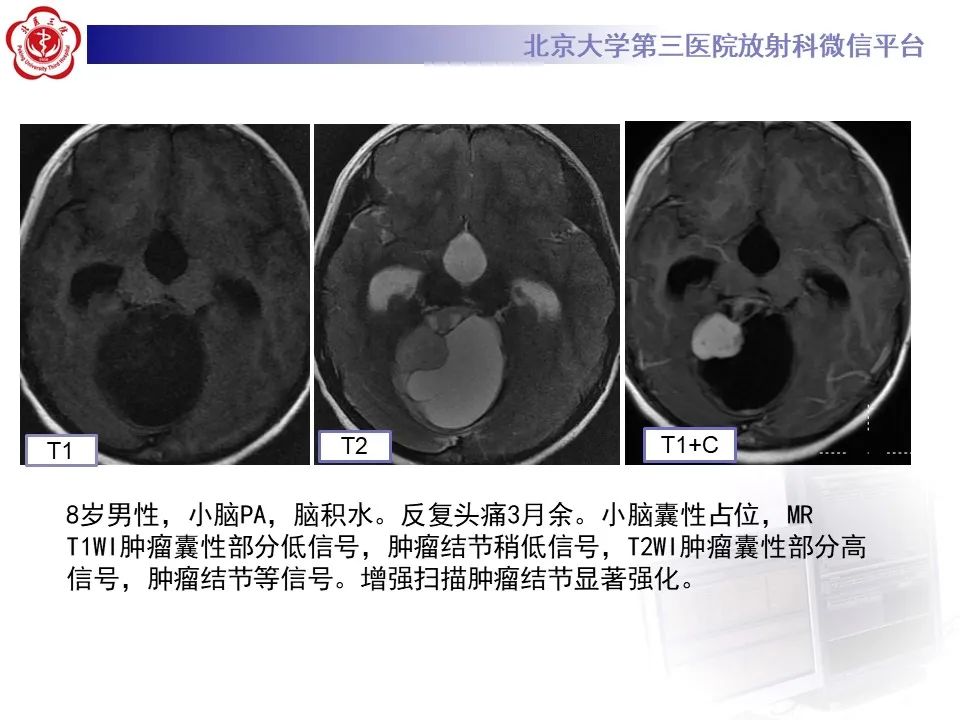 影像PPT - 【病例】四脑室毛细胞型星形细胞瘤1例MR影像-25